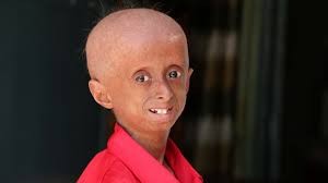 Very rare disease